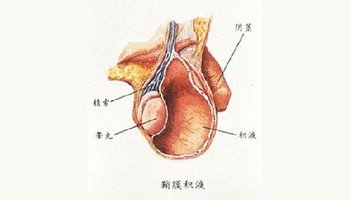 小儿睾丸鞘膜积液