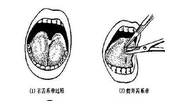 舌系带过短可通过手术矫正.手术的时间以2岁前幼儿说话之前为宜.