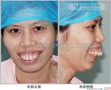 龅牙是东方人种中最为常见的一类牙颌面畸形,在医学专业上实质是上颌