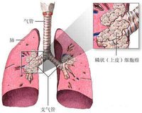 大多起源于较大的支气管,常为中央型肺癌.