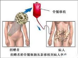 移植骨髓_360百科