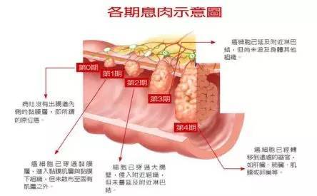 肛门外有颗小肉疙瘩是痔疮?它可能是痔疮另外