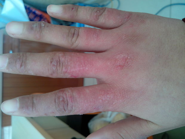 手上起了好多疙瘩,冷了疼,热了又好痒。_360问