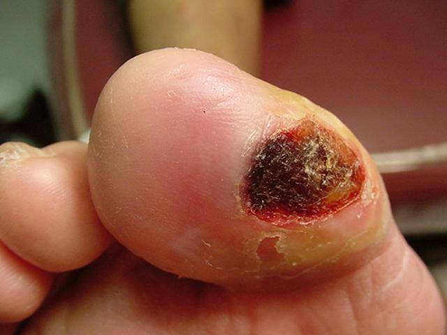 比糖尿病更可怕的6大并发症,看完真得好好控制血糖了!