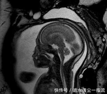 胎儿筛查畸形的最佳时间?每天坚持吃点,让孕妈