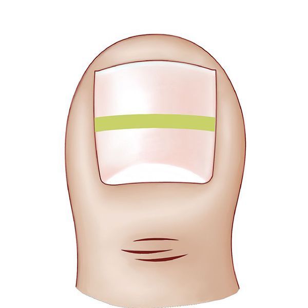 甲沟炎拔甲根之后指头红肿发痒,是什么原因