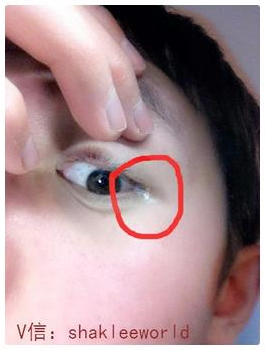 两眼外眼角有白色分泌物是咋回事