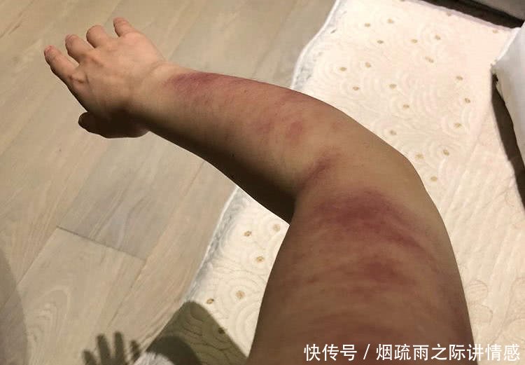 杨丞琳理疗身体之后出痧不减,手臂红肿让人心