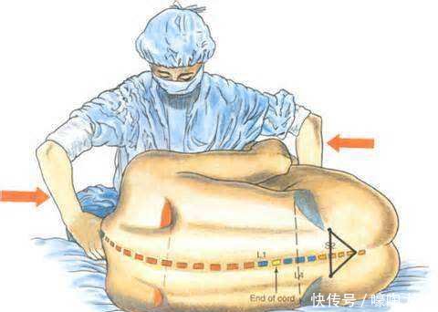 剖宫产术后,孕妇腰酸背痛的原因是什么?