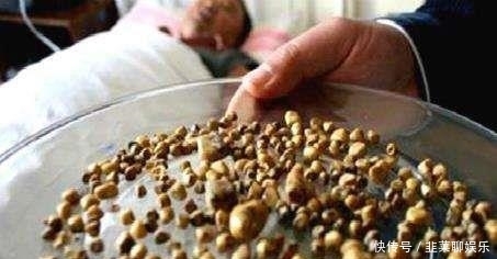 20岁男子肾脏长满40颗“石头”,医生:这种食物惹的祸! 通博官网app