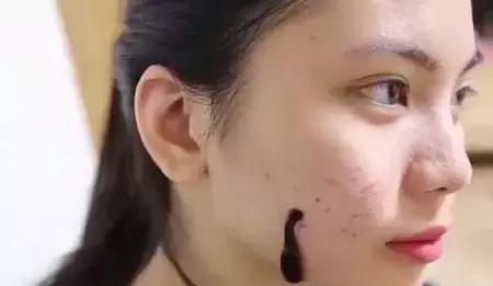 美女将水蛭放在脸上让它吸血,20秒之后她笑的合不拢嘴