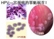 人<em>乳头瘤病毒</em>感染的有效预防措施有哪些?_36