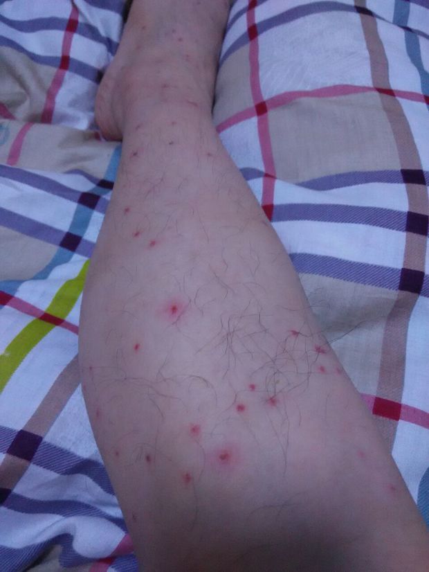 孕育早教 腿上的小红点是什么情况 linyzh:红疹吧?