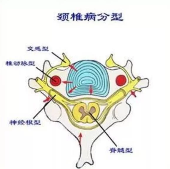 成天喊着肩膀酸,这点颈椎病防护知识了解一下 - 云栖雅韵博客 - 云栖雅韵博客 t014844e901cc3e0f5e.jpg?size=578x576