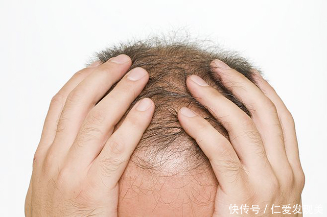发少、秃顶的原因有哪些,头发稀少怎么变浓密