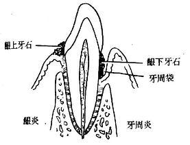 牙槽脓肿