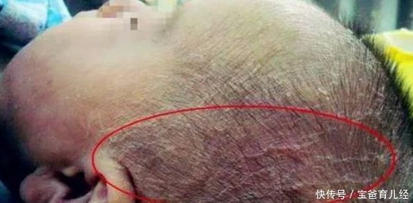 宝妈扣去宝宝的乳痂,宝宝发烧不止,医生的话