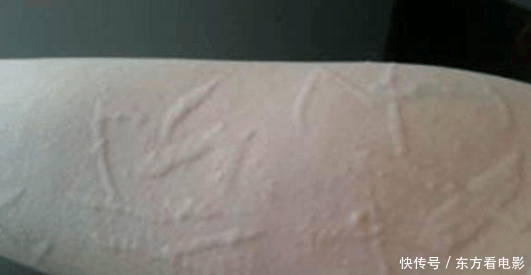 身上起一片一片的红疙瘩, 如何快速止痒才有效