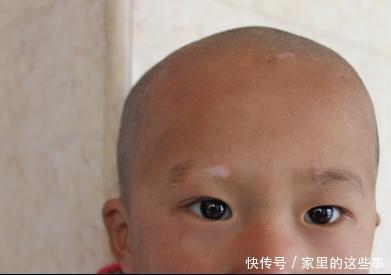 孩子脸上长白斑,经常肚子疼、不吃饭,医生:都是