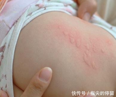 荨麻疹止痒小妙招有哪些 这六个止痒方法帮你
