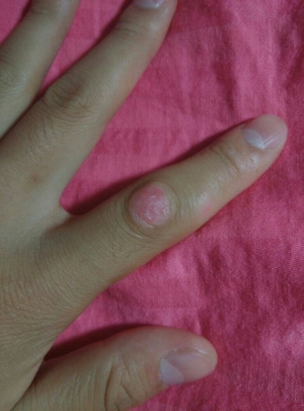 手指关节皮肤角质