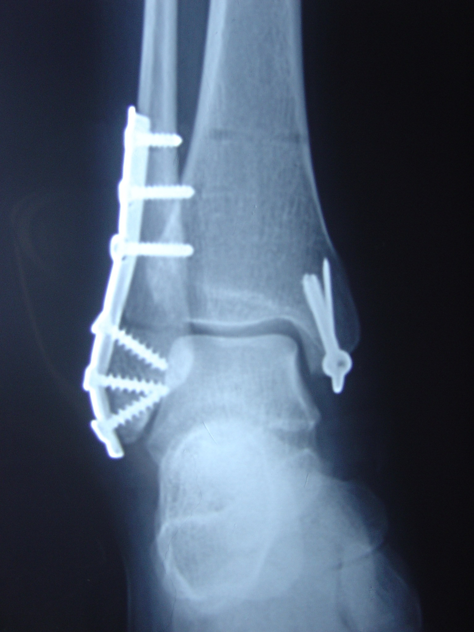 黄骨头踝关节骨折—三踝骨折一例（前外+后内侧入路） - 骨科专业讨论版 -丁香园论坛