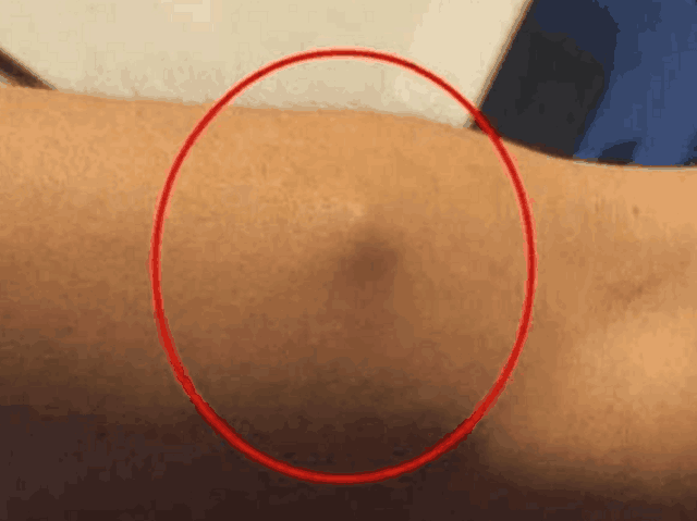 男子胳膊疼痛似肿瘤,手术后竟取出这东西,医生都想不明白!