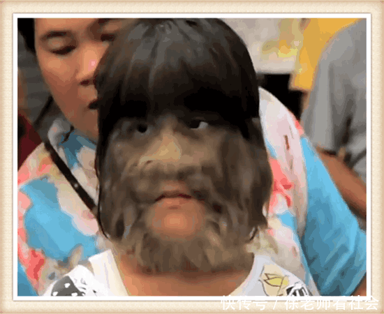 女子曾经脸上长满毛发, 现在脱掉毛发晒出和对象照片, 网友纷纷祝