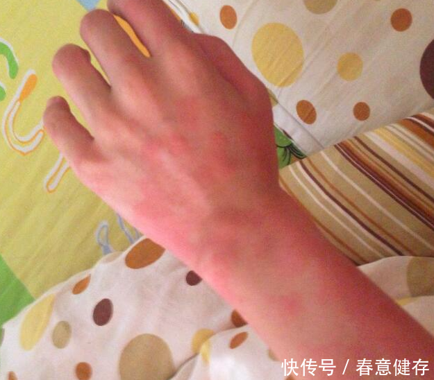 止瘙痒,祛湿气,治荨麻疹,我们是专业的!