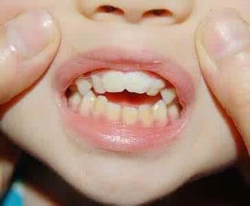 石萍:小孩牙齿不齐的另一个原因"腺样体肥大"