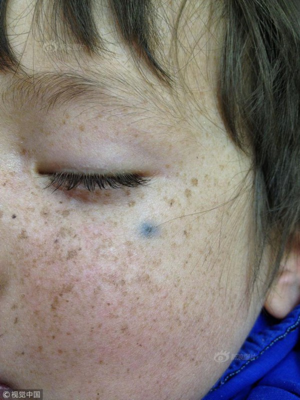 男孩患罕见病对阳光过敏 出门变宇航员