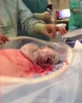 医生为孕妇剖腹后让婴儿自己爬出母体 - 谭笑古今 - 谭笑古今 医生为孕妇剖腹后让婴儿自己爬出母体 - 谭笑古今 - 谭笑古今