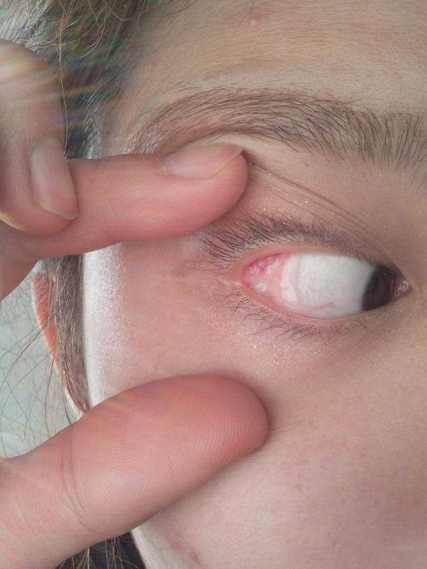 眼角增生 结膜囊肿