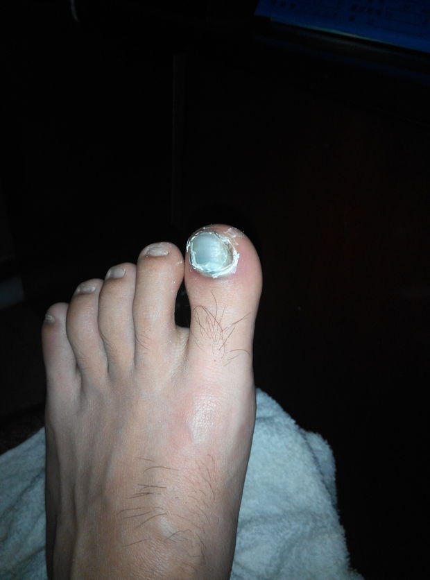 脚趾甲被砸淤血一天后洗脚干了以后周围出现一种白色物质是什么