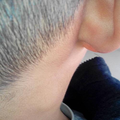 后颈部肿块图片