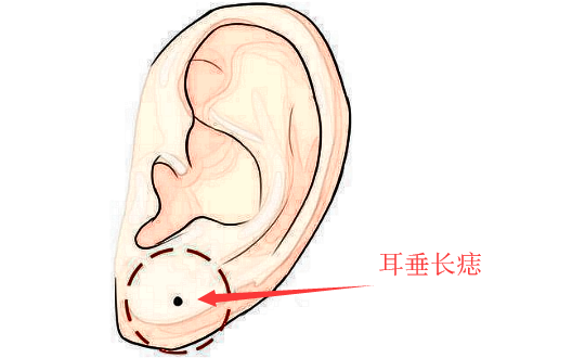 旺财痣，身上此处长善痣，发横财，进偏财，看你脸上得是不是？