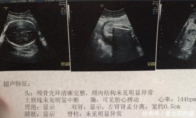 什么时候可以出现肾盂分离 t018628b2016128b790.jpg