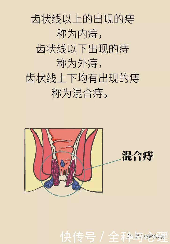 得了痔疮是一种什么样的体验?