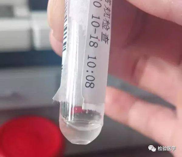 小项目的大作用--1例小儿化脓性脑膜炎快速诊