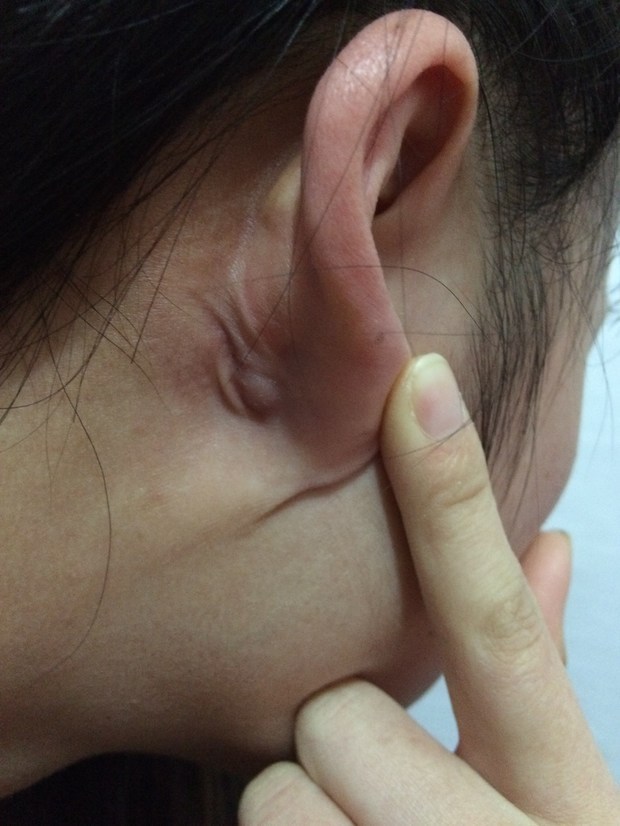 耳朵后面长了个硬包_360问答