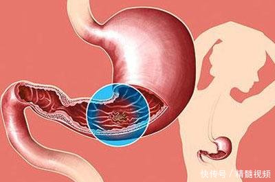 胃癌的早期症状 胃病癌变的四大征兆_【快资讯