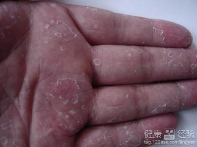 季节性手脱皮_手脱皮是怎么回事