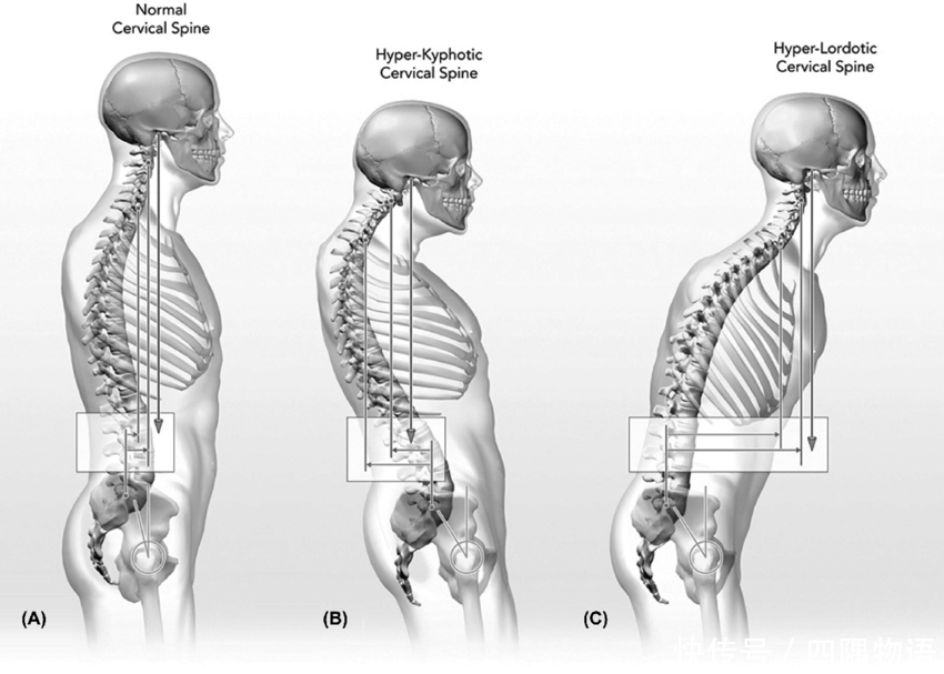 颈椎自然曲度变直 :颈部和背部疼痛的根源
