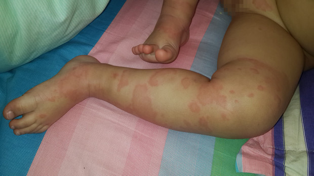 一岁半幼儿皮肤过敏去小门诊看了说是荨麻疹全身几乎