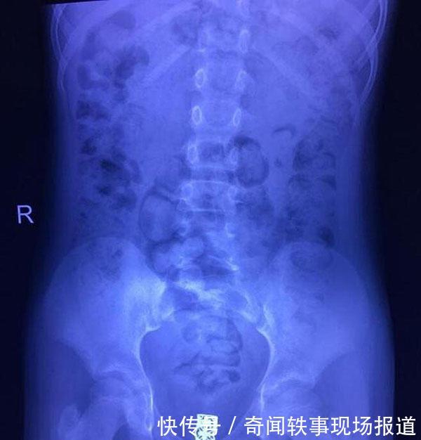 女孩下身疼痛3年,发出臭味总被人嘲笑,医院拍