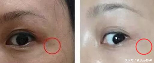 什么是皮秒激光?做一次有效果吗?