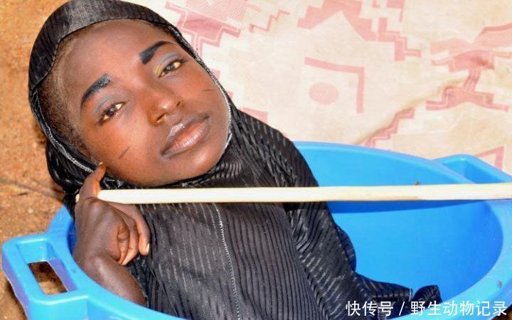 十九岁女孩身患怪病全身截肢仅剩头部依然坚强活着，网友：奇迹