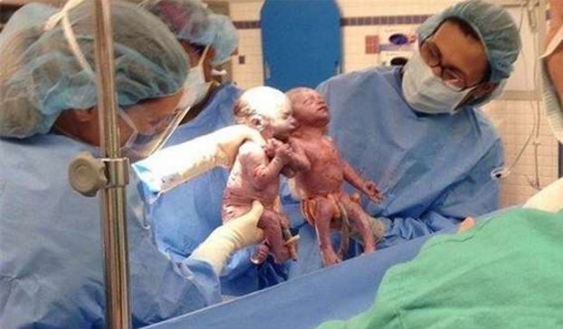 双胞胎姐妹花手牵手一起出生,如今2岁依旧是