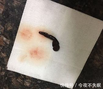 17岁女孩常流鼻血，医生从她鼻子取出一物，女孩看到吓坏了