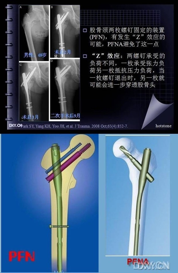 pfn手术后的z效应有谁能解释下,鲜花伺候